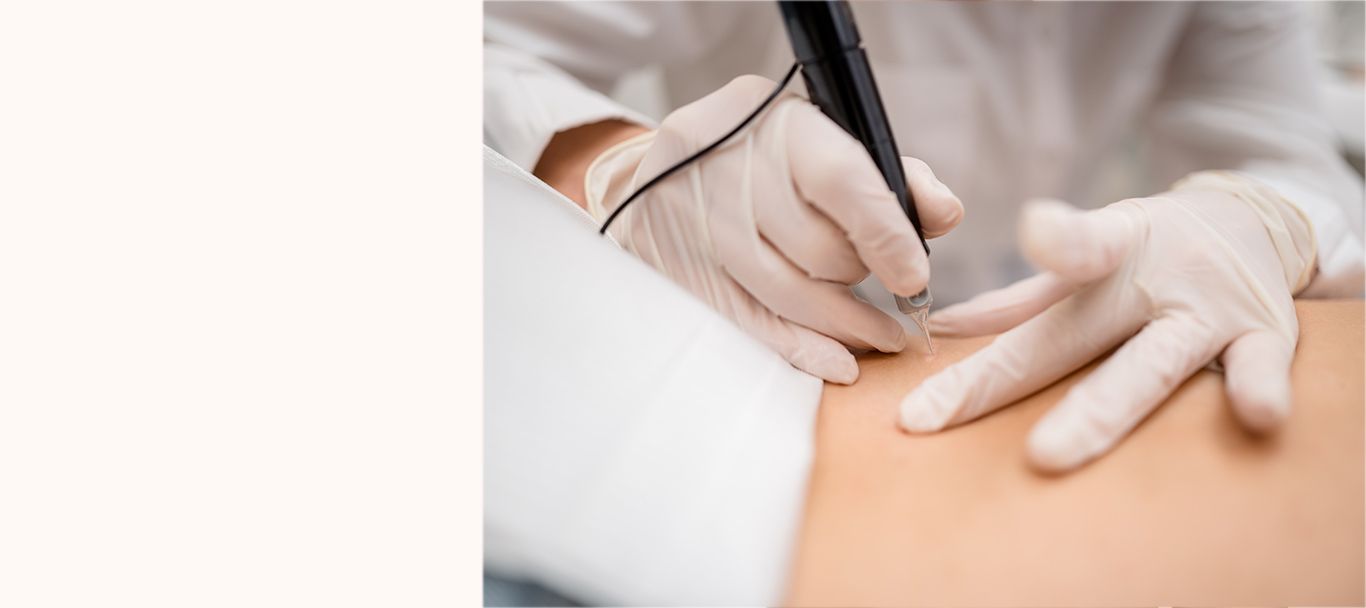 Medizinische Pigmentierung - Frau oberkörperfrei bedeckt Brust